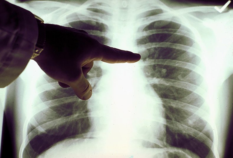 Lung xray