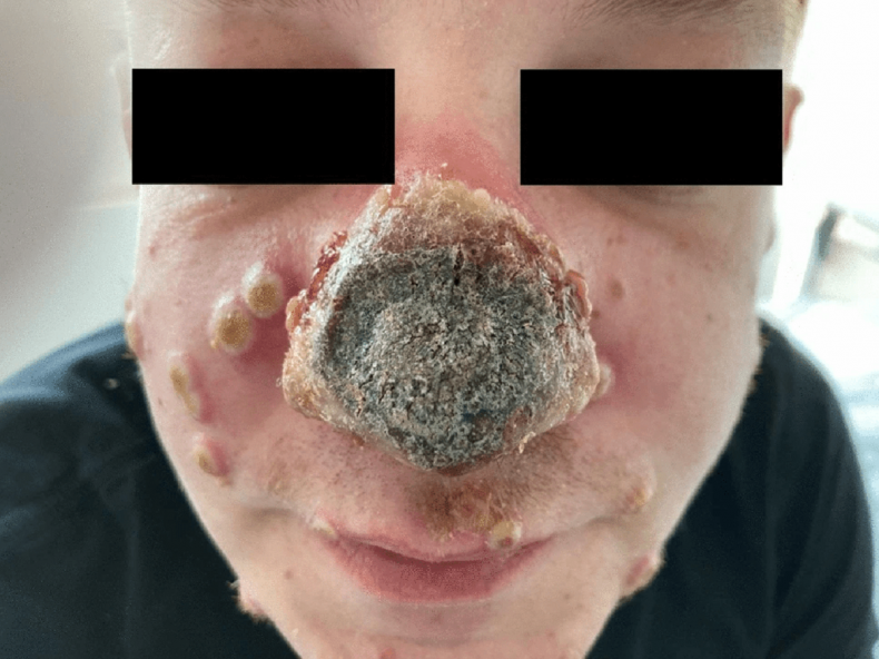 Monkeypox patient's affected nose