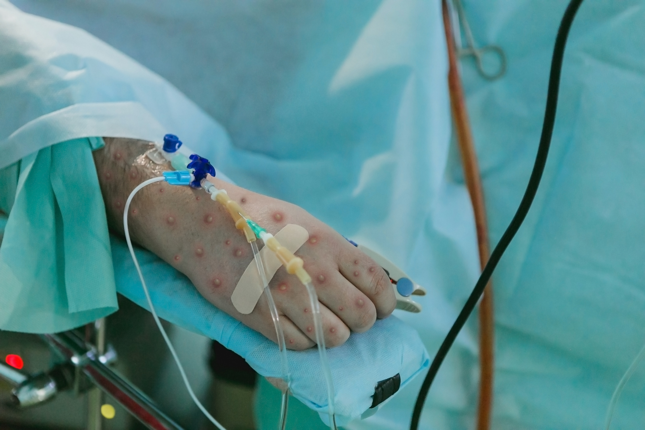 Which Kids Are Most at Risk From Monkeypox?