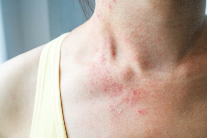 A rash