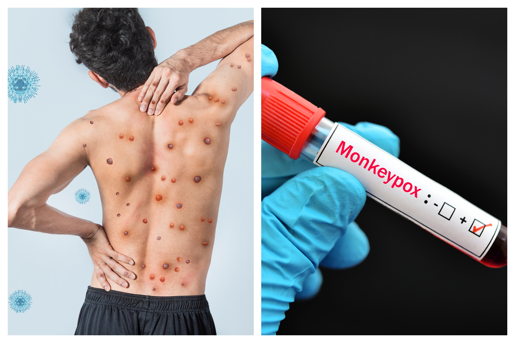 Patient With New Strain of Monkeypox Hospitalized in U.K.