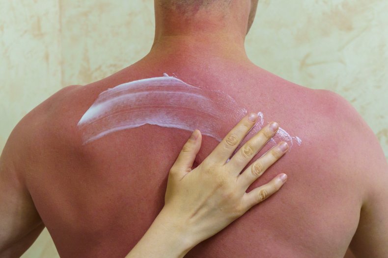 Ces horribles habitudes endommagent votre peau sans même que vous vous en rendiez compte 2 Un homme avec un coup de soleil