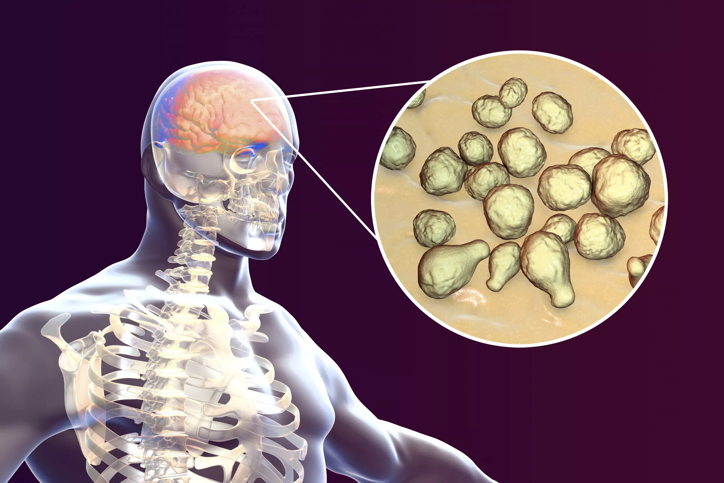 Deadly Fungus Can Shape-shift Its Way Deep into Your Brain: 'Shocked' - Vimarsana News