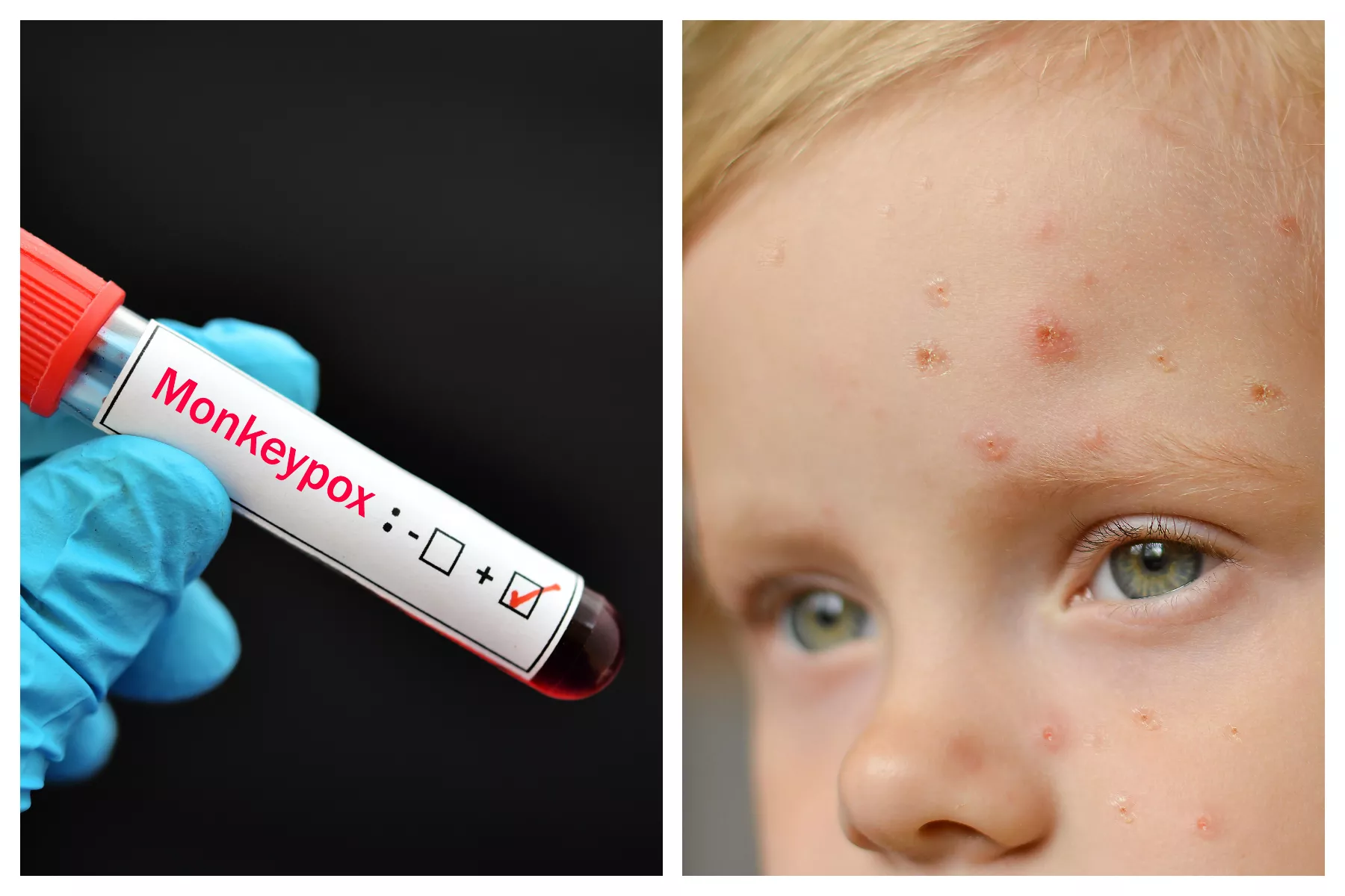 Baby Under 2 Months Contracts Monkeypox in Florida - Vimarsana News