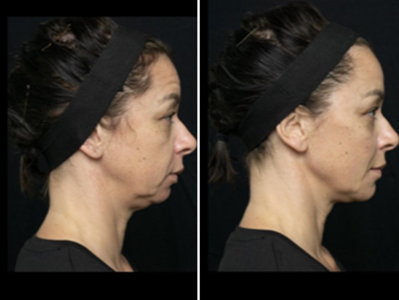 Full Face Rejuvenation Side Angle