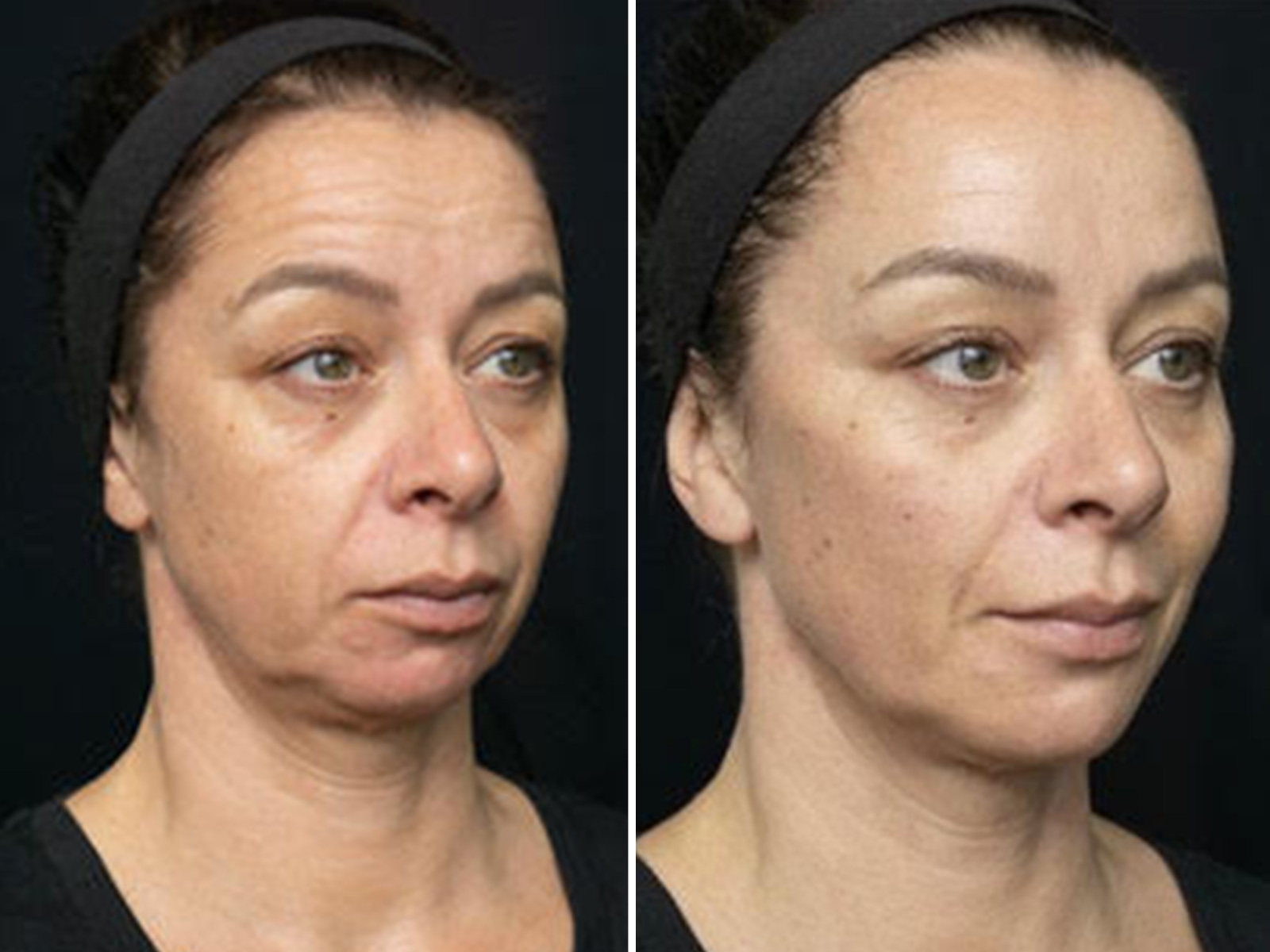 The New 'Revolutionary' Rejuvenation Procedure That Can Transform Your