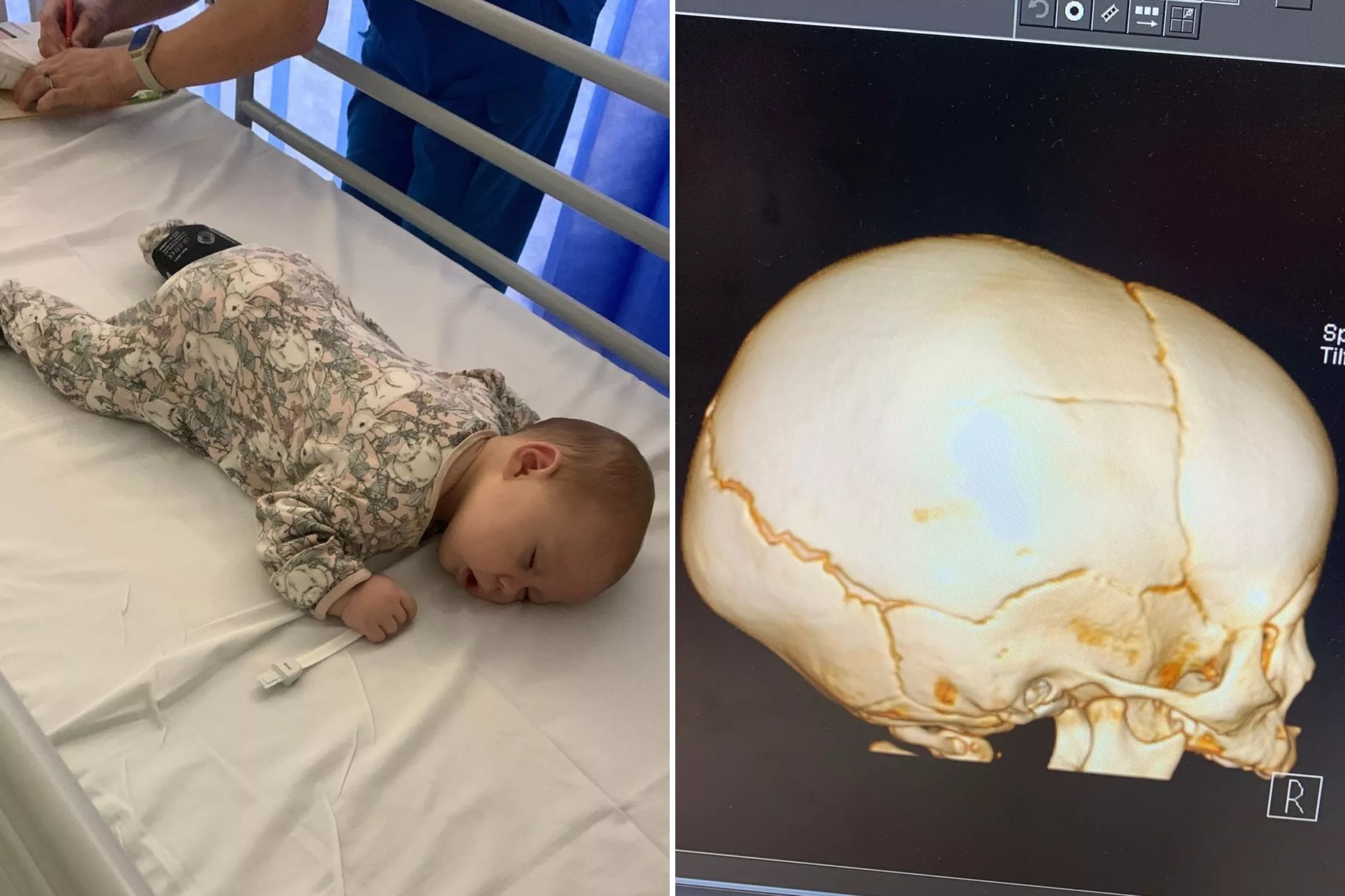 Mom Shares Stark Warning About Babies After Sickening Skull Injury: 'Shock' - Vimarsana News