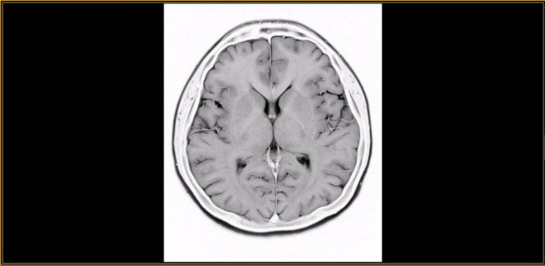 MRI scan of healthy male brain.