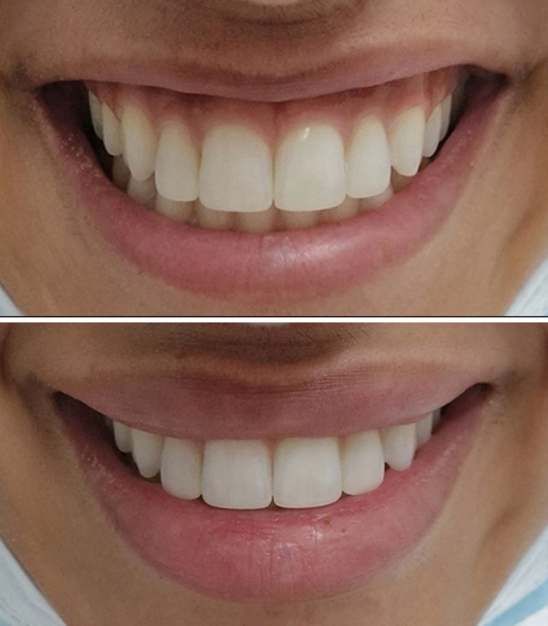 Lip Flip Smile Before And After List 100+ Pictures Before And After Lip Flip Photos Superb