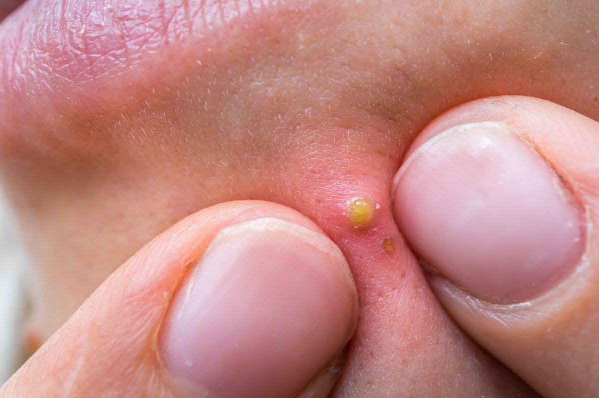 A woman popping a pimple