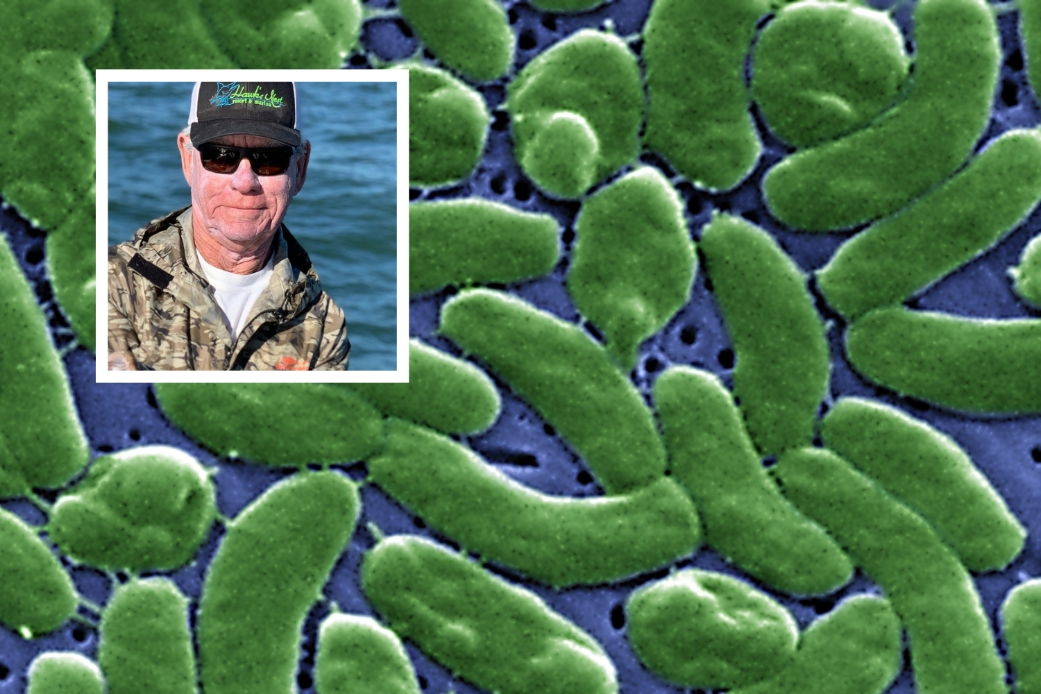'I've Had the Vibrio Vulnificus That Is Plaguing Florida'