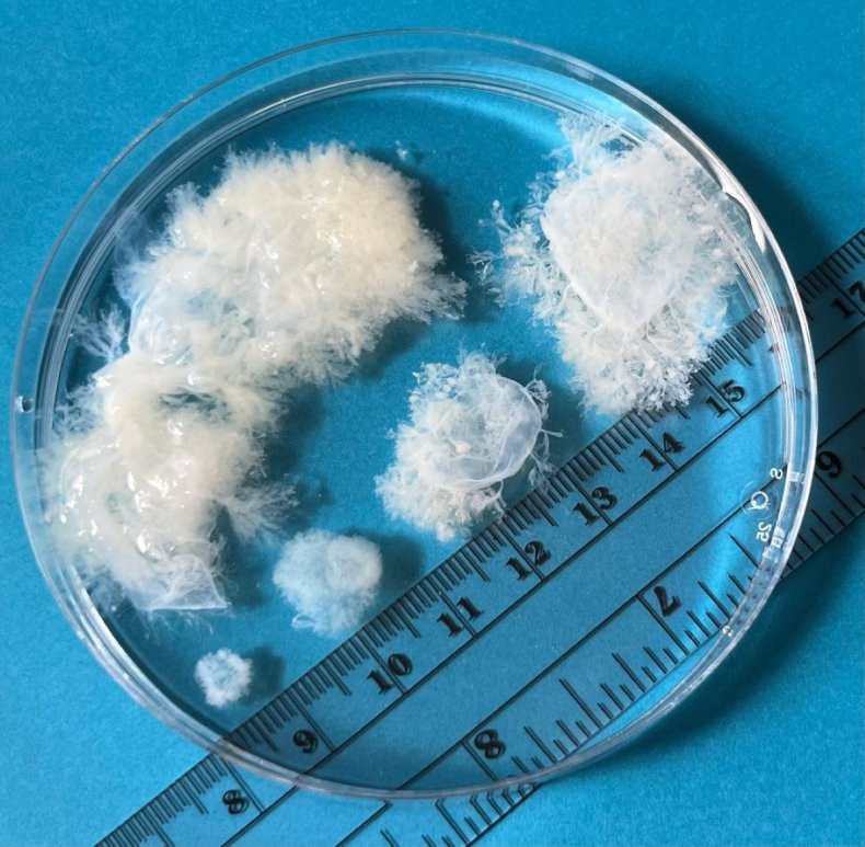 Pregnancy tissue at 5 to 9 weeks