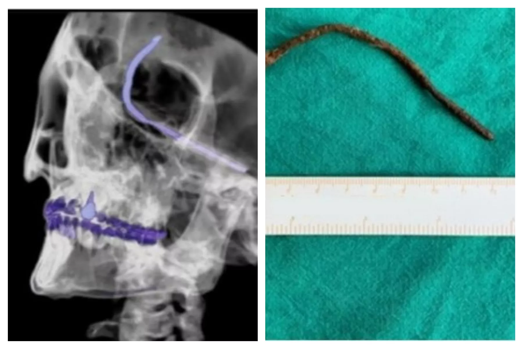 Man Survives Brain Skewered With Metal Rod: 'A Lucky Escape' - Vimarsana News