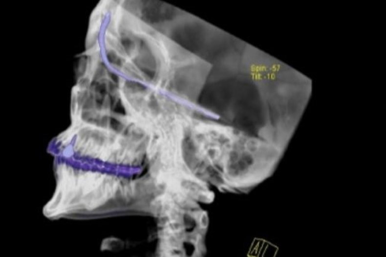 rod in head