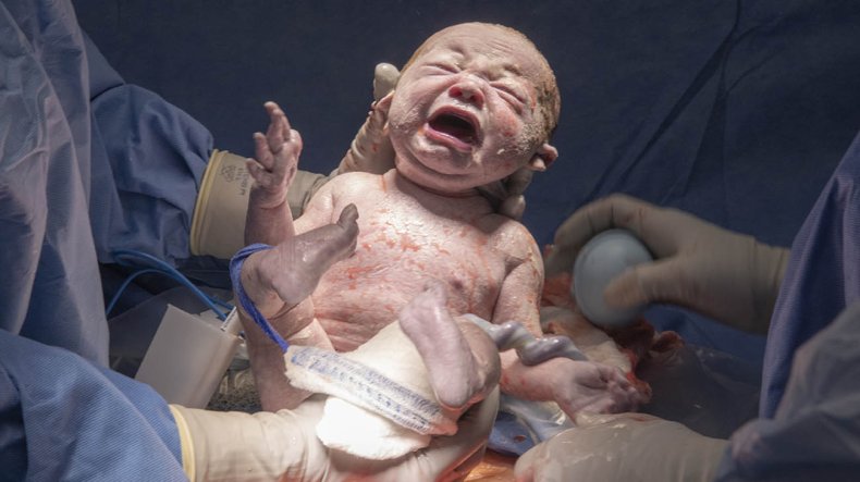 Baby Grace shortly after birth