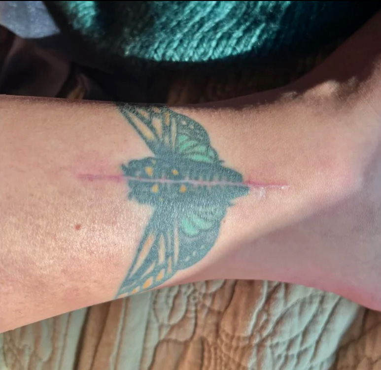 People Are Getting Medical Tattoos to Cover Scars From Surgeries