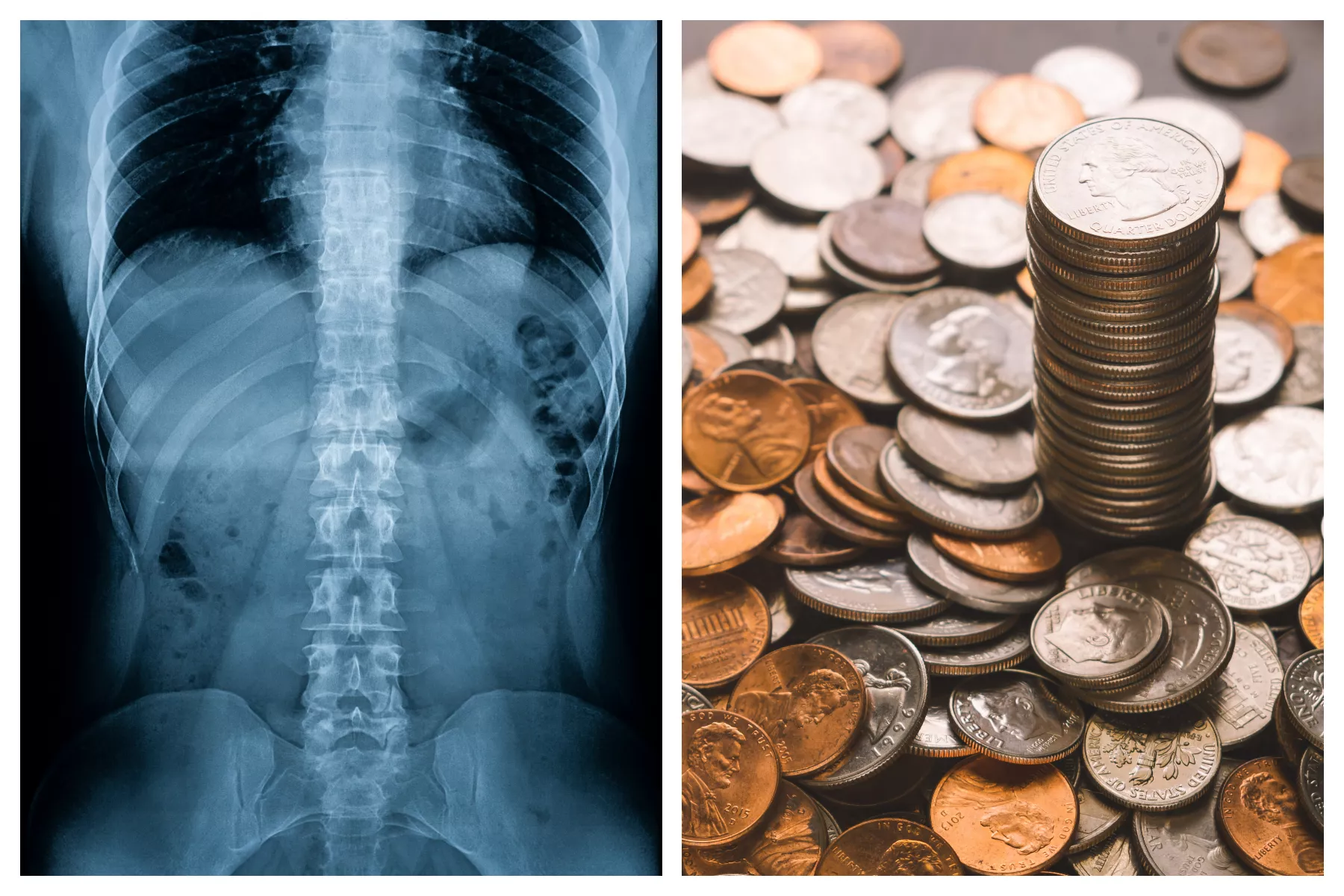 X-ray Reveals Nearly 200 Coins in Man's Enormously Dilated Stomach - Vimarsana News