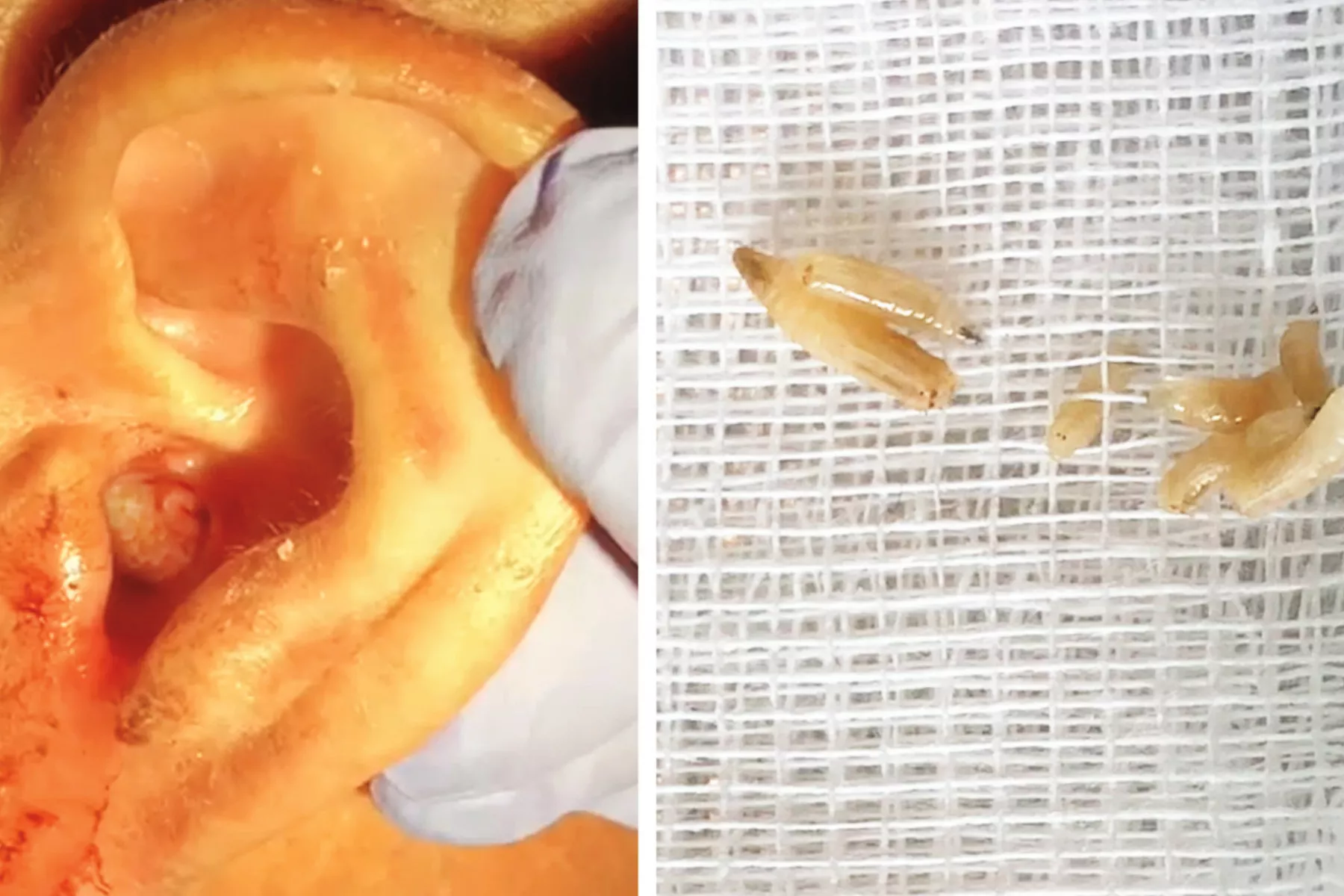 Man's Ear Infested With Flesh-Eating Maggots That Were Feasting on Eardrum - Vimarsana News