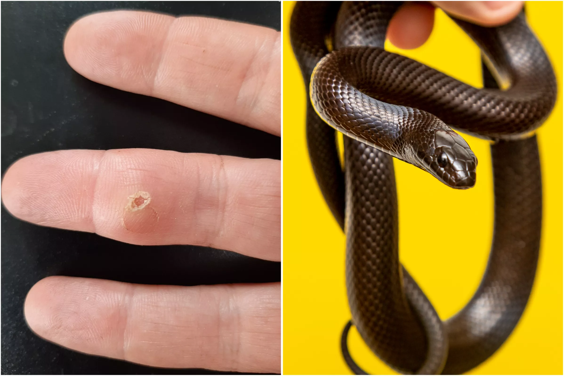 Snake Tooth Found Lodged in Man's Finger After a Year of 'Unmerciful Pain' - Vimarsana News