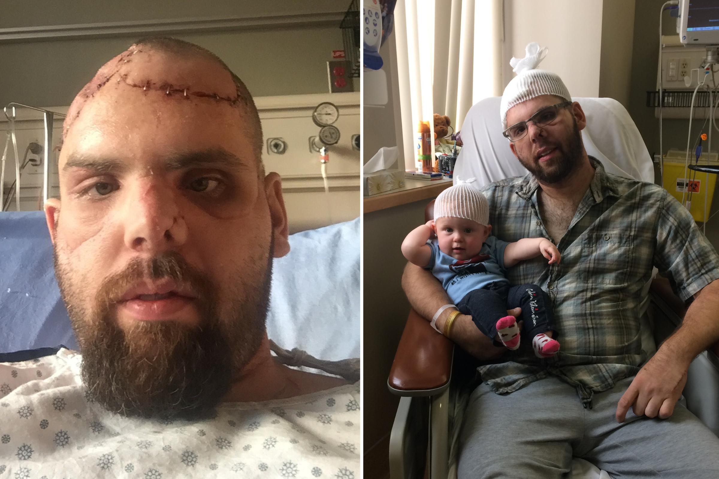 Man Who Escaped After Bear Crushed His Skull on How He Survived