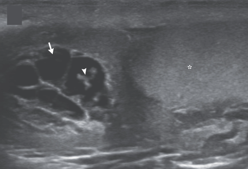 Pemindaian ultrasonografi pasien filariasis limfatik