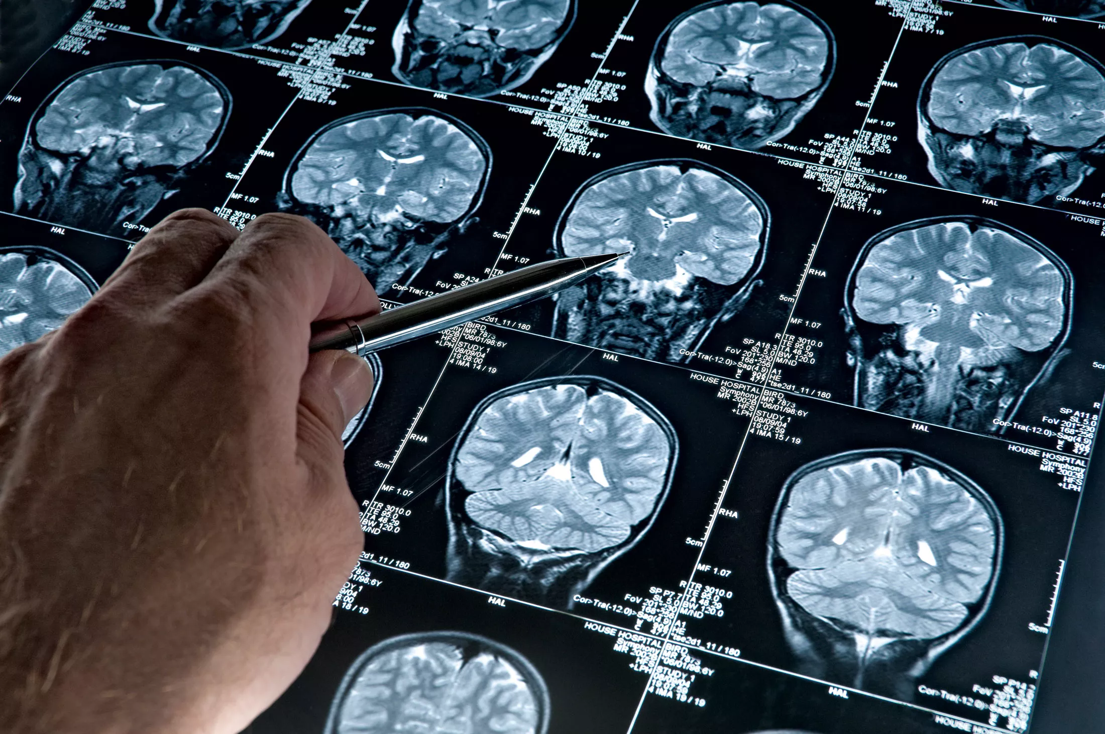 New Alzheimer's Drug Brings Hope—and Tough Choices for Patients, Caregivers - Vimarsana News