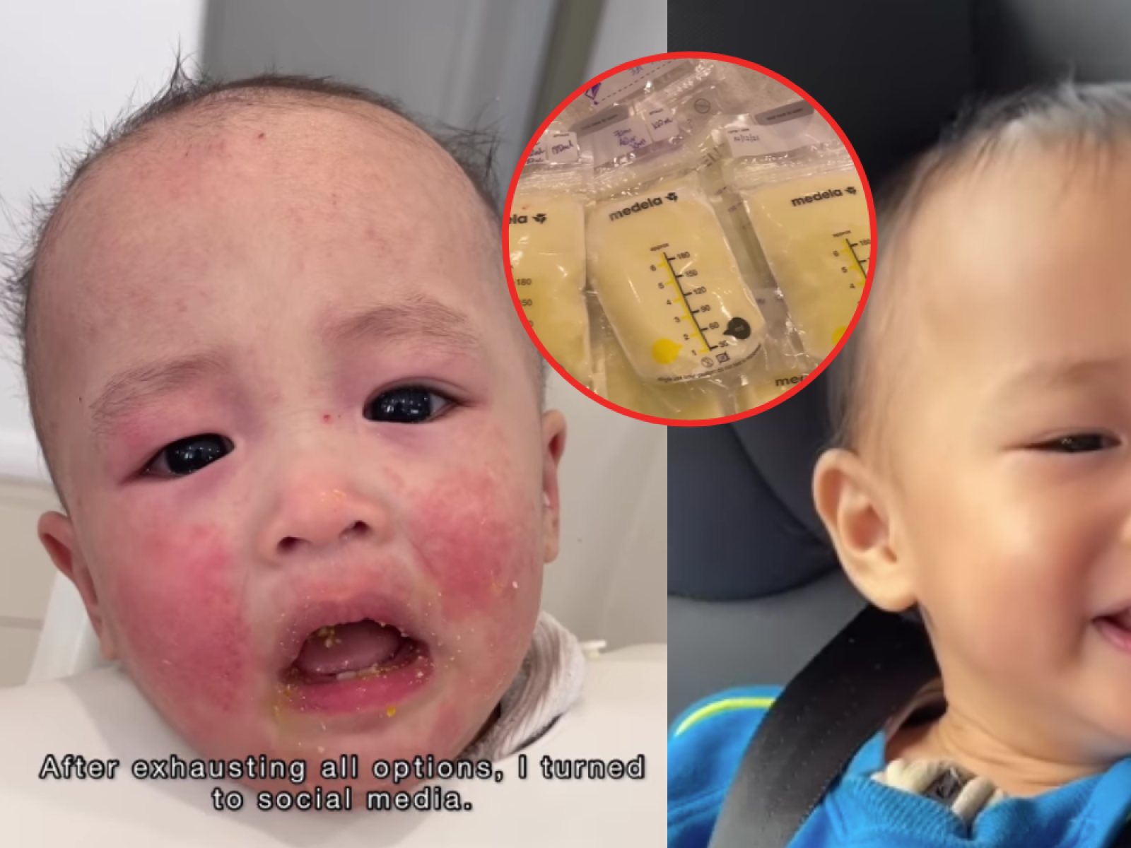 Baby allergic best sale to breastmilk