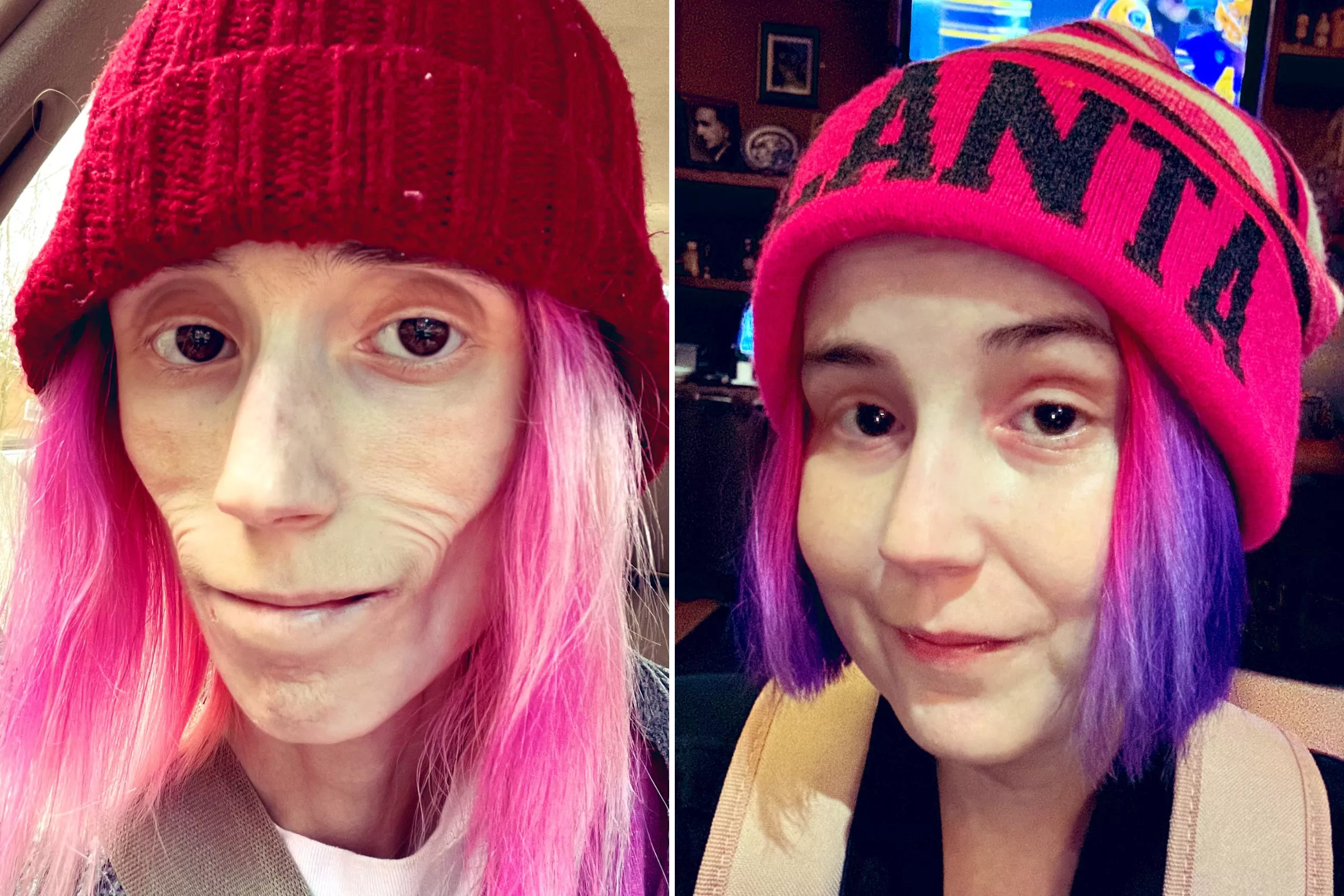 This Is The Untold Story Of How a Woman Weighing 35 Pounds Defied All Odds - Vimarsana News