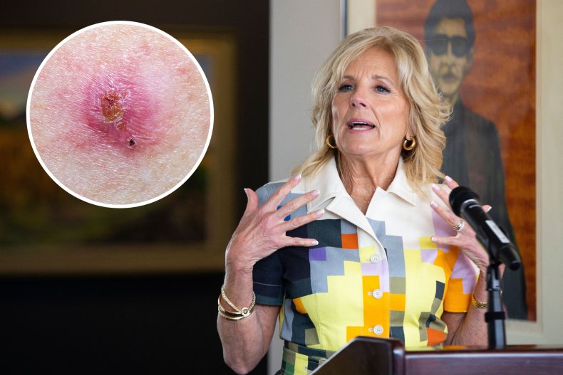 Basal Cell Carcinoma Jill Biden Skin Cancer