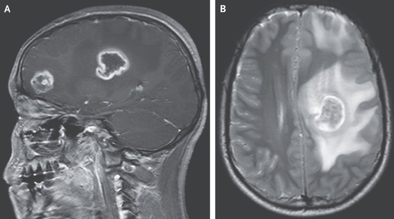 Brain lesions caused by parasitic disease