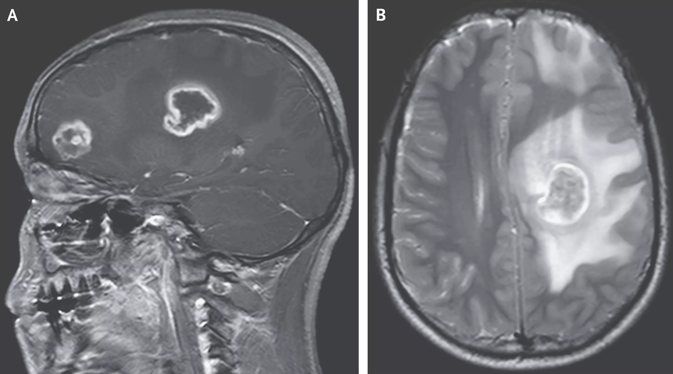 Boy's Brain Started to Rot After Rare Parasitic Infection - Vimarsana News