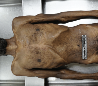 Autopsy Photo of Larry Eugene Price, Jr.