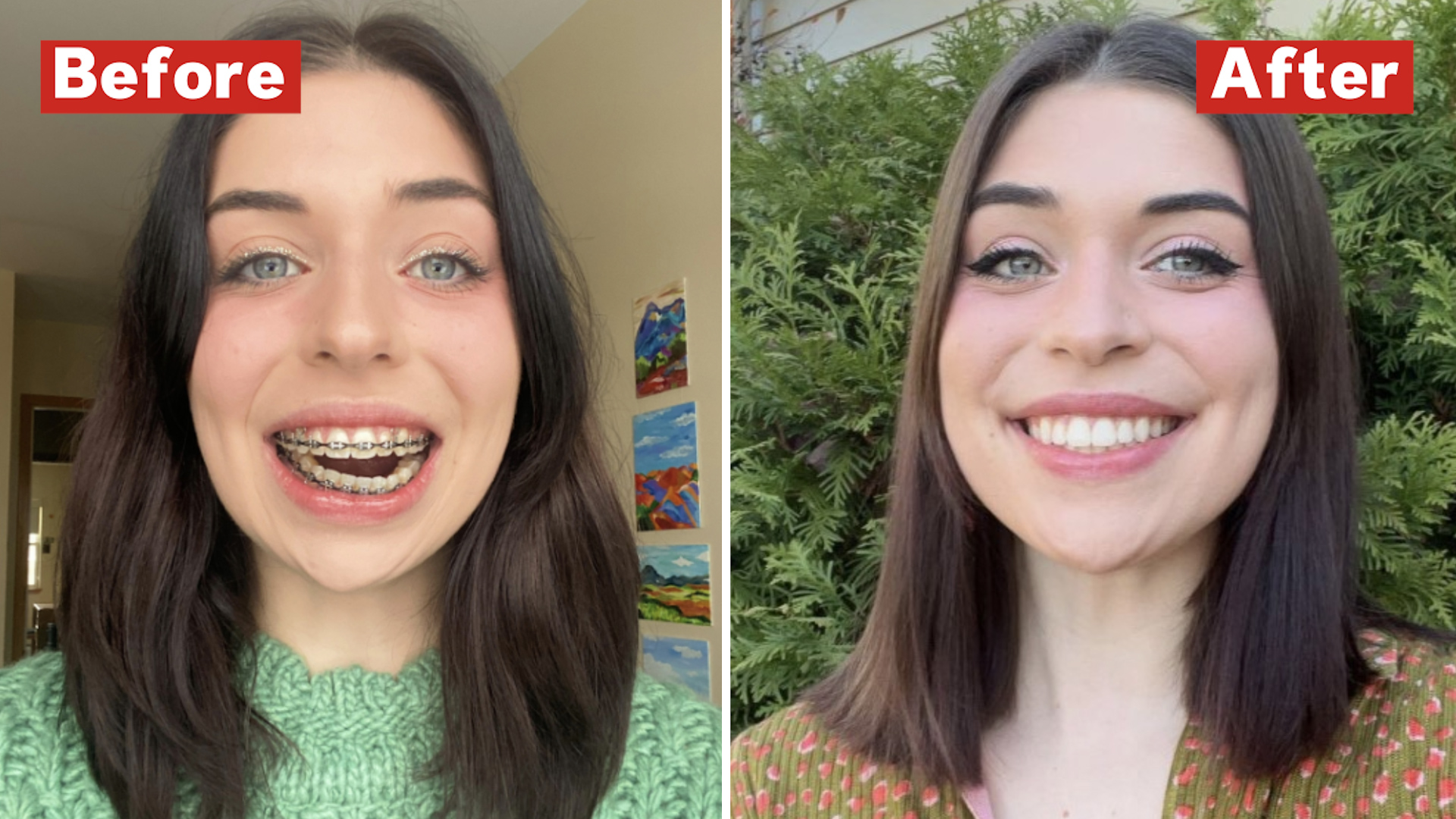 How Long Does Lower Jaw Surgery Take