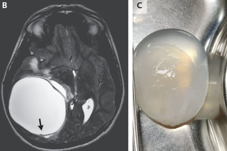 A cyst removed from a boy's brain