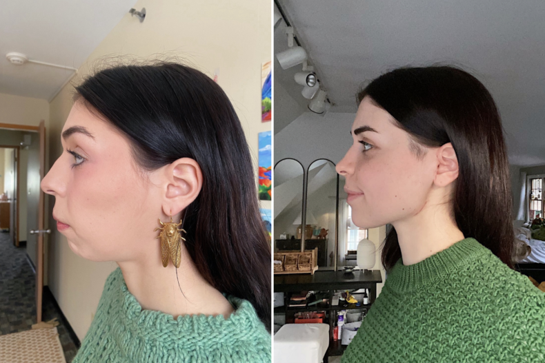 Roman's side profile before and after surgery