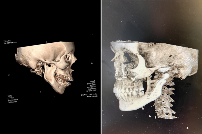 Before and after scans of Roman's jaw