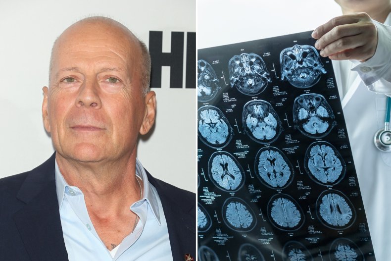 Bruce Willis Frontotemporal Dementia FTD Diagnosis Health