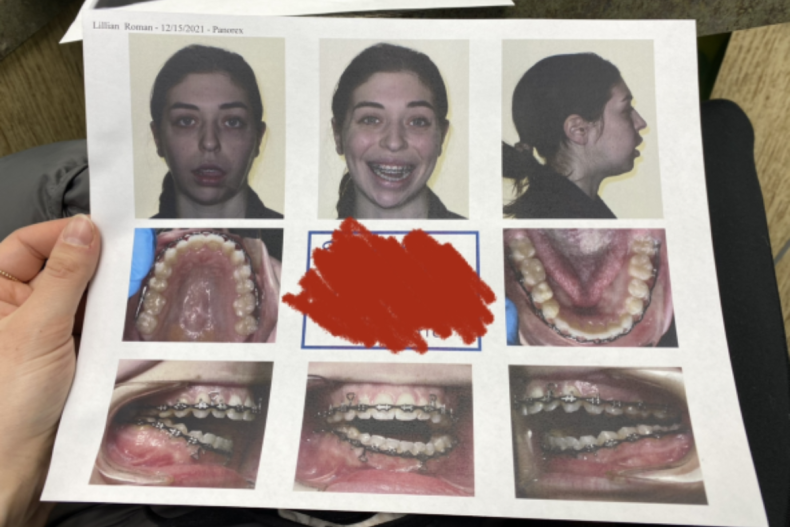 Pre-surgery photos: Roman's teeth, bite and jaw