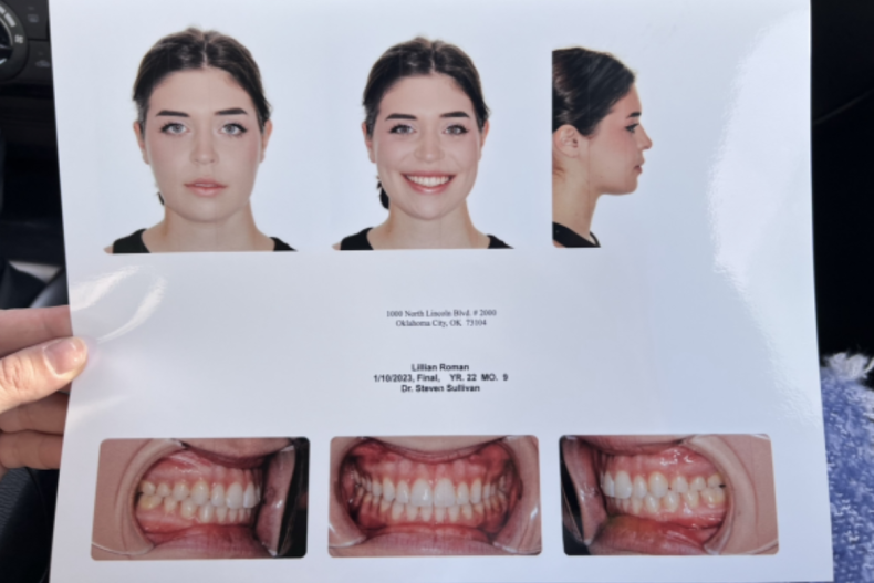 Post-surgery photos: Lillian's bite, smile, jaw, teeth.