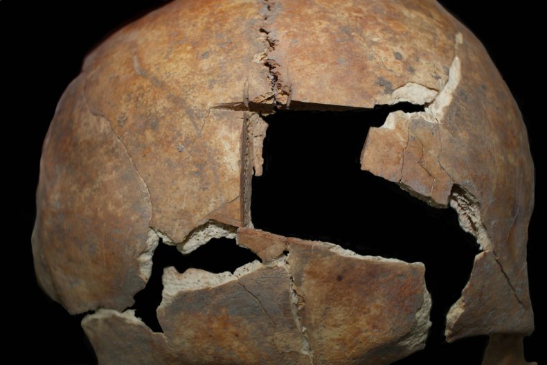 Trepanasi