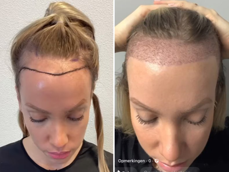 Are Female Hair Transplants on the Rise? Two Women on Their Hair Loss