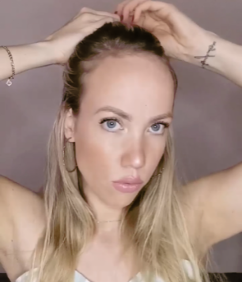 Operasi transplantasi pra-rambut Sonja van den Berg