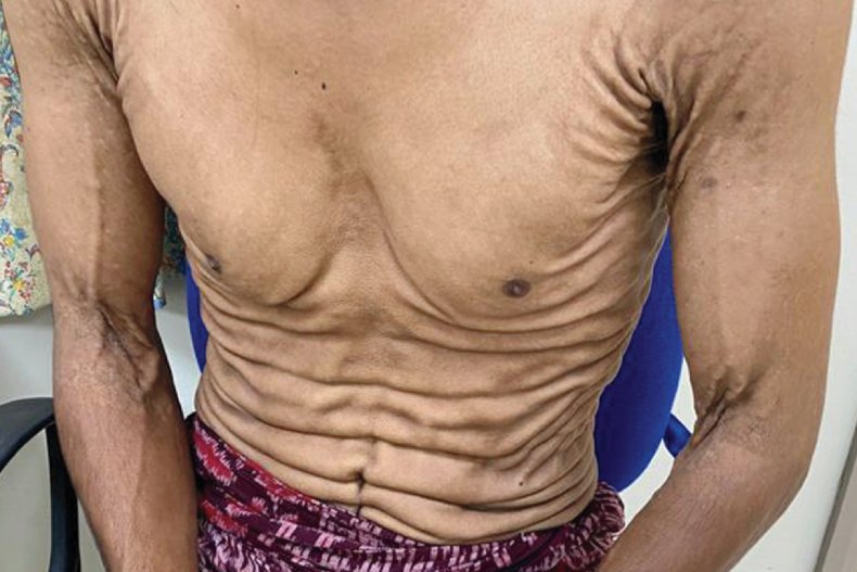 Man with a “Pseudoxanthoma elasticum-like” syndrome