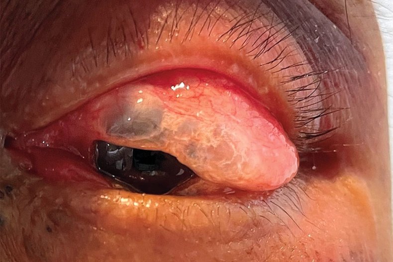 A man with orbital emphysema