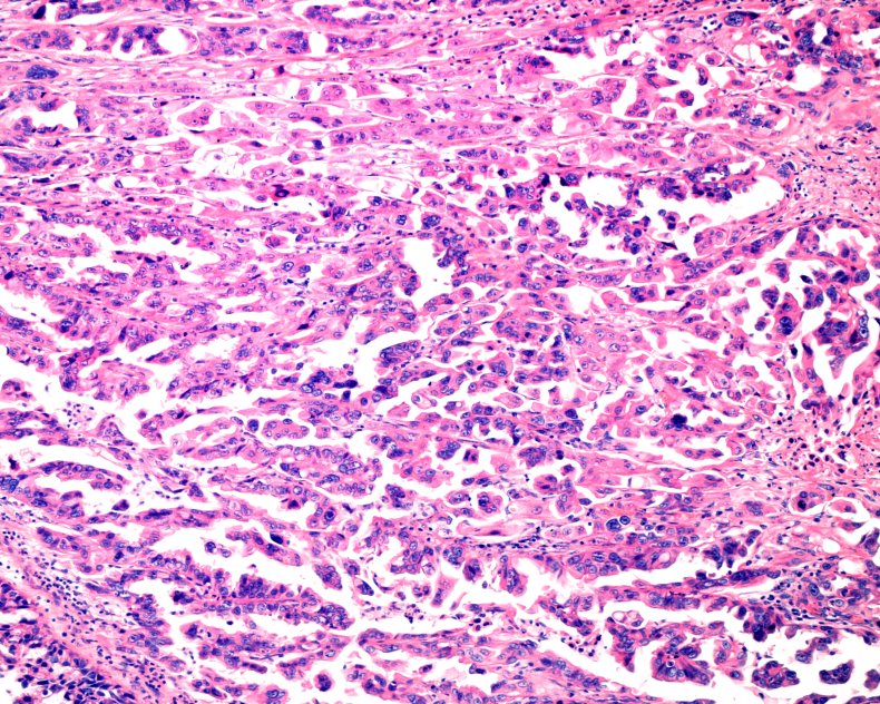 ovarian cancer
