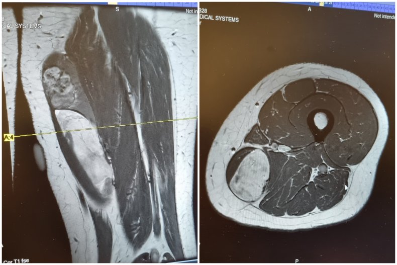 Tumor in thigh scans