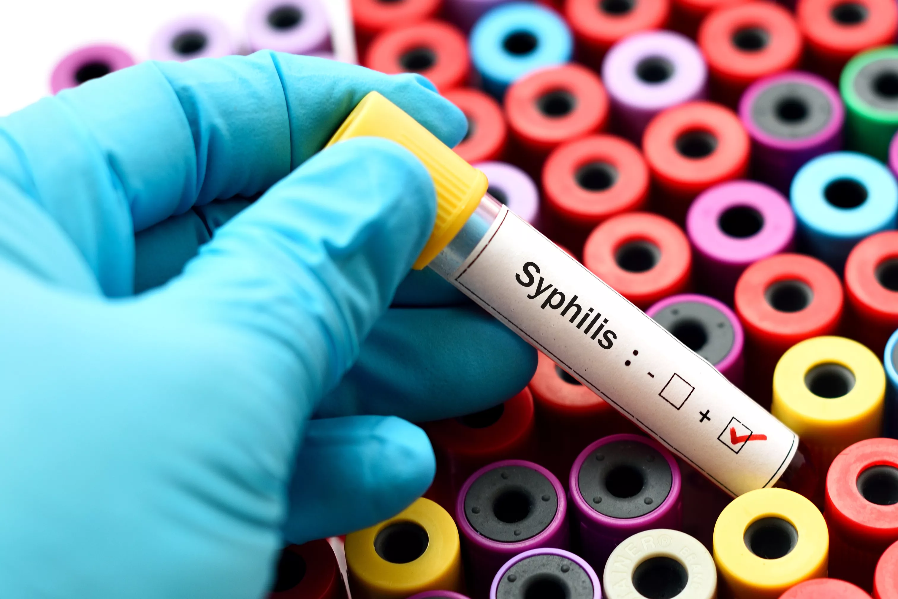 Why Syphilis Is on the Rise - Vimarsana News