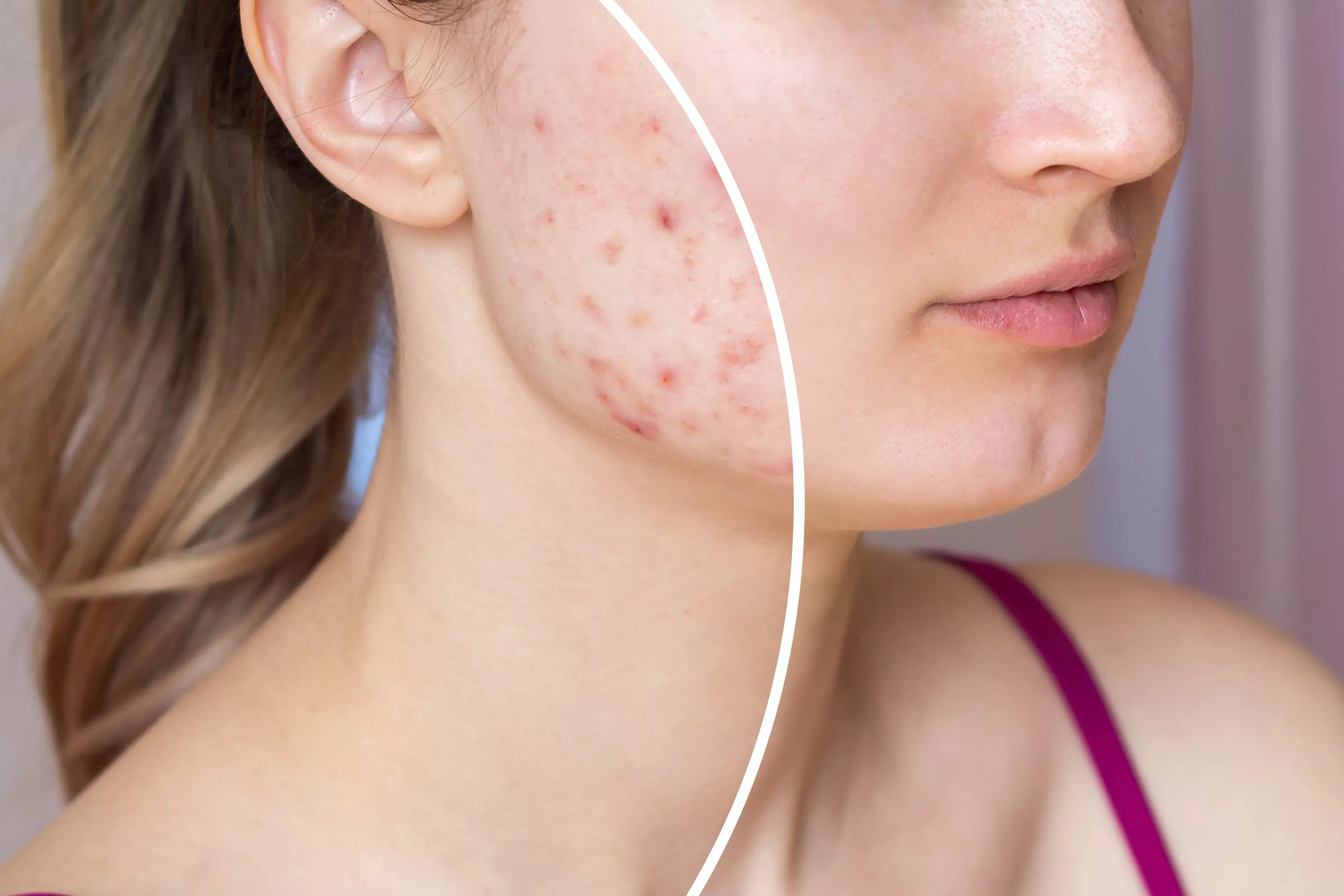Is Tap Water Ruining Your Skin? A Dermatologist Tells All - Vimarsana News