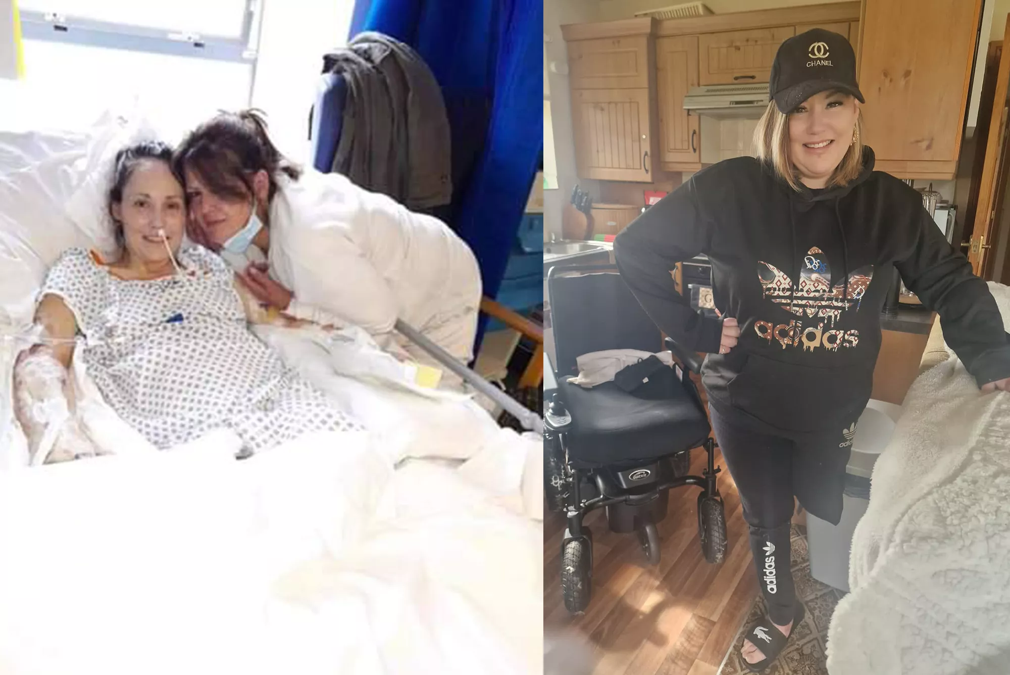 'A Living Nightmare:' Woman Recalls How Flesh Eating Bug Destroyed Her Body - Vimarsana News