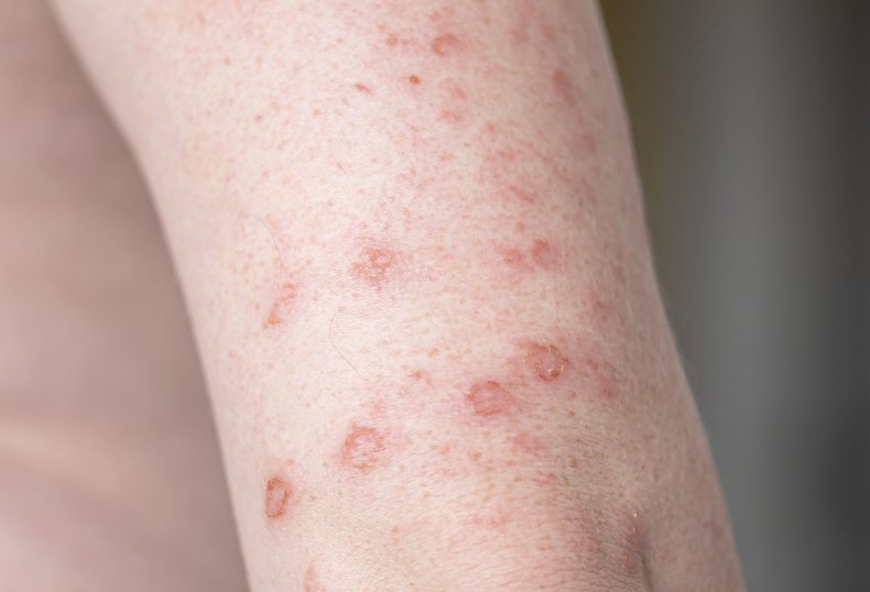 Hives on a man's arm